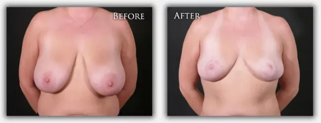 Breast Reduction before & after image