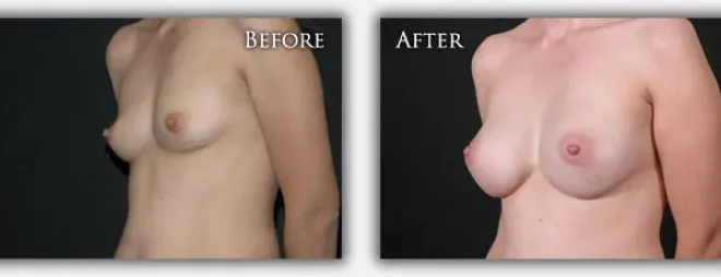 Breast Augmentation before & after photo