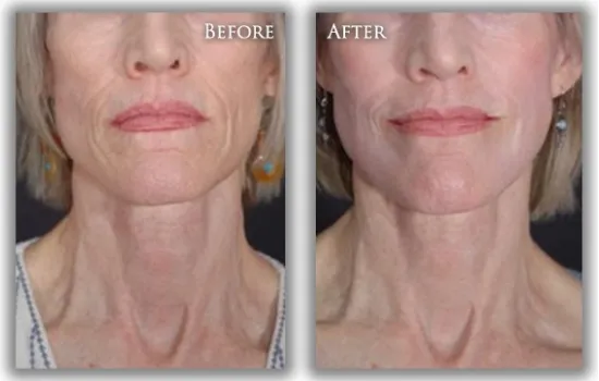 Chemical Peel before & after photo