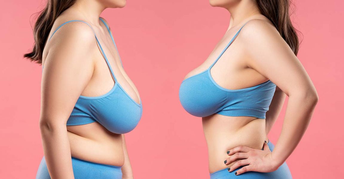 Breast reduction surgery in tucson arizona