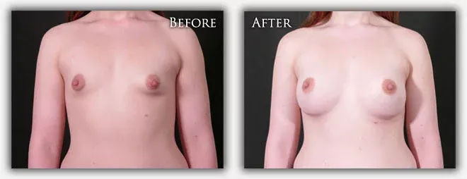 Breast Augmentation before & after photo