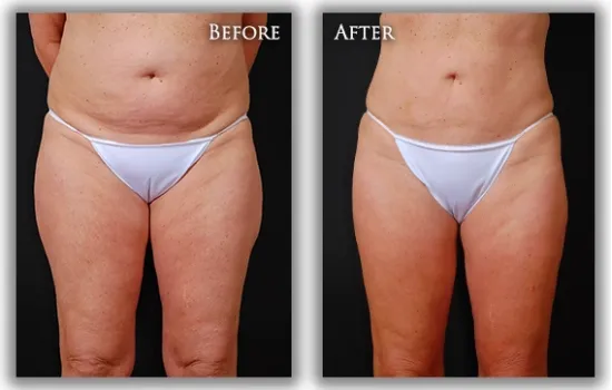 Liposuction before & after image