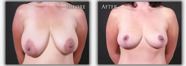 Breast Lift before & after image