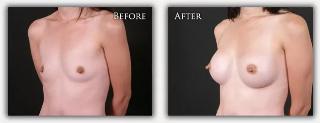 Breast Augmentation before & after photo