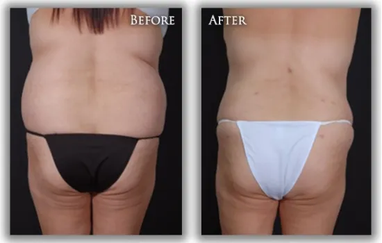 Liposuction before & after image