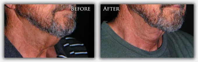 Neck Lift before & after picture