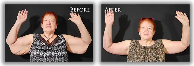 Arm Lift before and after photo