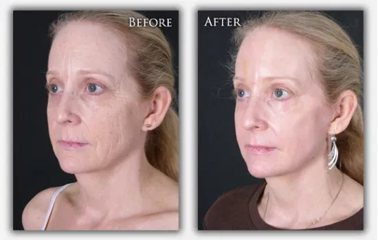 Chemical Peel before & after photo