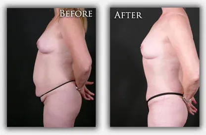 Tummy Tuck before & after picture