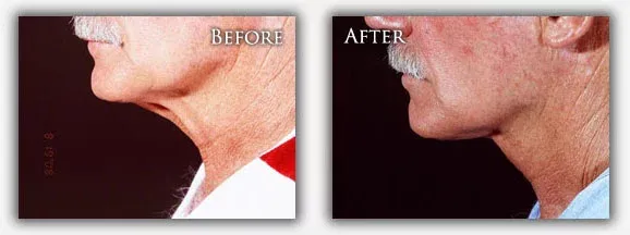 Neck Lift before & after picture