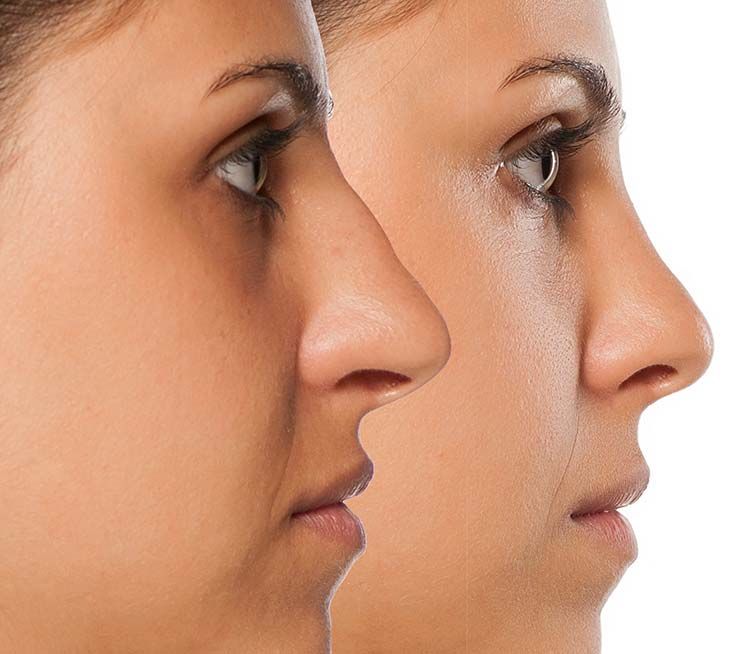 Rhinoplasty surgery in tucson arizona