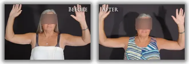 Arm Lift before and after photo