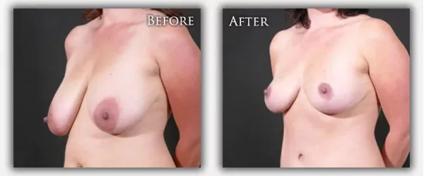 Breast Lift before & after image