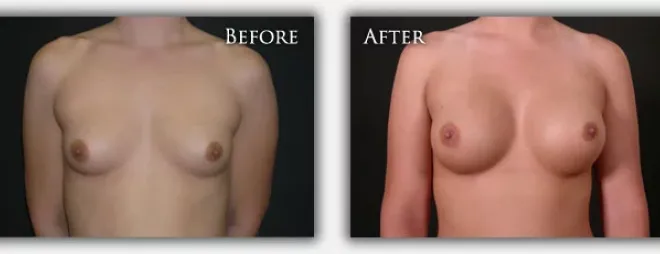 Breast Augmentation before & after photo