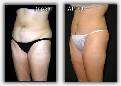 Tummy Tuck before & after picture