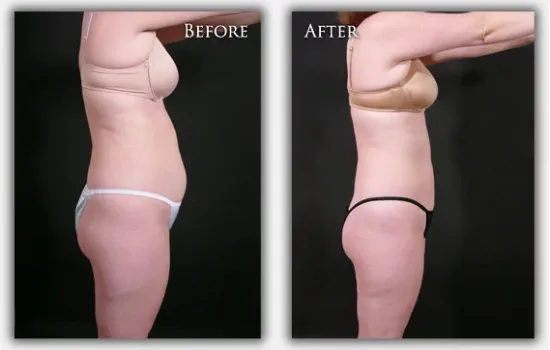 Liposuction before & after image