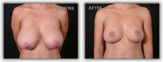 Breast Reduction before & after image