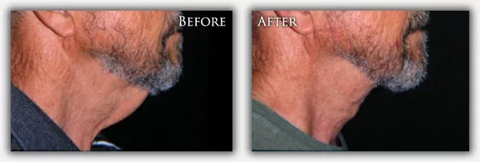 Neck Lift before & after picture