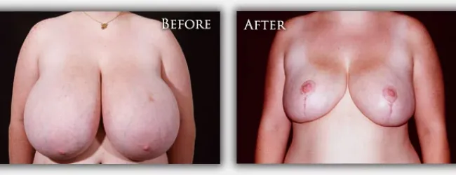 Breast Reduction before & after image